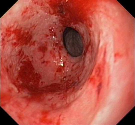 GASTRITIS