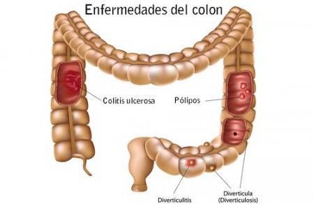 ENFERMEDADES DEL COLON